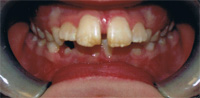 Portruding front teeth