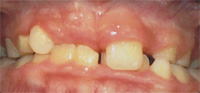CrossBite